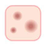 しこりニキビ　紫ニキビ