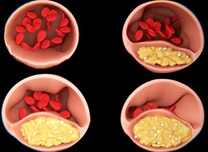 動脈硬化の症状