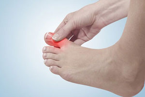 痛風の症状と原因を解説